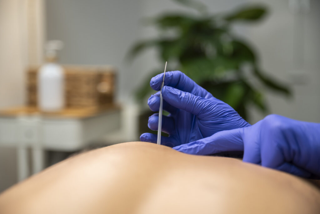 Fisioterapeuta realizando punción seca en clínica de fisioterapia en Tres Cantos