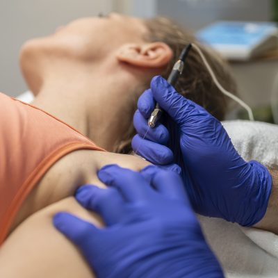 Tratamiento de fisioterapia con punción seca para dolor muscular y sobrecargas